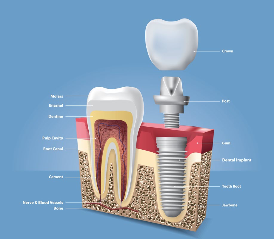 Root Canal Therapy