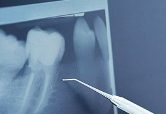 After Zirconia Anterior Crowns