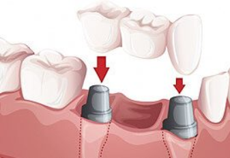 After Clear Aligner Orthodontics (Invisalign)